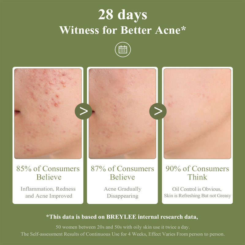 Tea Tree Acne Gel 15g Emergency Type Amazon Cross-border