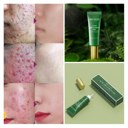 Tea Tree Acne Gel 15g Emergency Type Amazon Cross-border